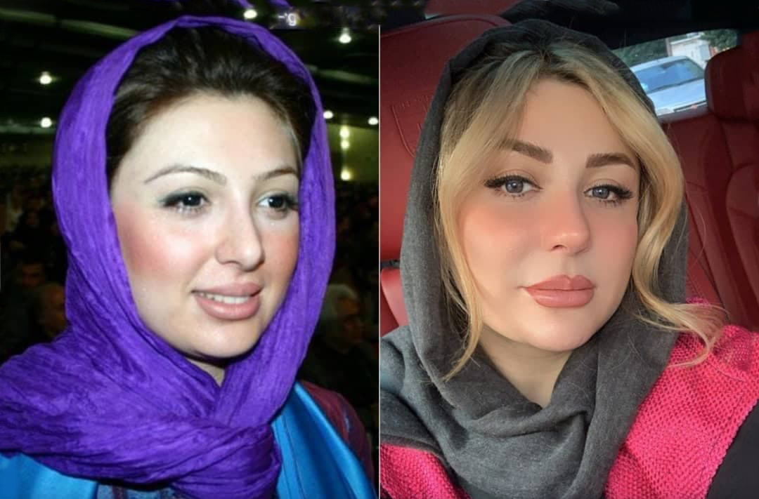 عکس دیده نشده نیوشا ضیغمی قبل از عمل زیبایی عکس دیده نشده نیوشا ضیغمی قبل از عمل زیبایی
