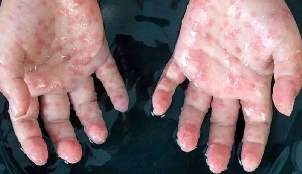 توصیه یک پزشک به رعایت پروتکلهای بهداشتی در مقابله با آبله میمونی توصیه یک پزشک به رعایت پروتکلهای بهداشتی در مقابله با آبله میمونی